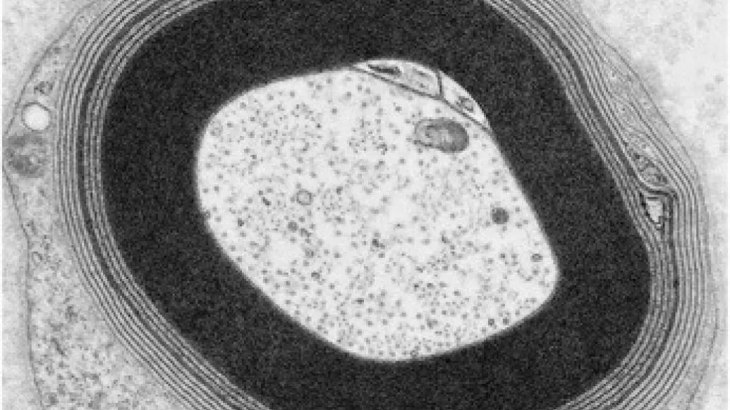 Wide spacing & irregular shaped layers of the myelin in a patient with anti-MAG neuropathy (electron microscopy)