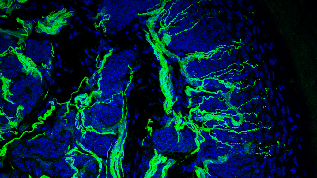 assessing intraepidermal nerve fiber density from a skin biopsy showing nerve fibers