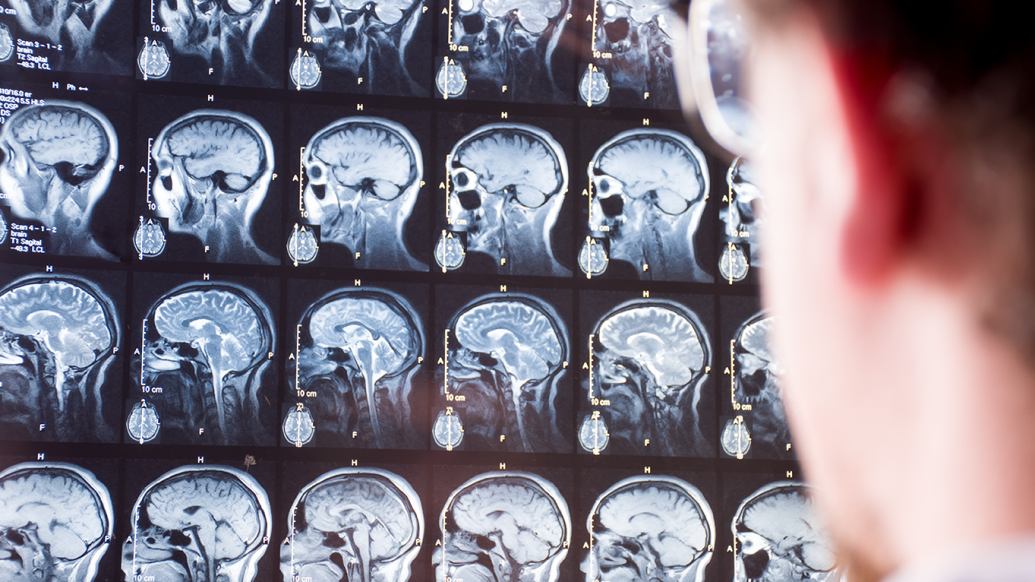 Clinician looking at brain MRI images