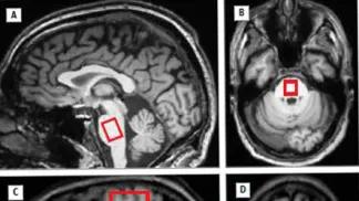 brain imaging