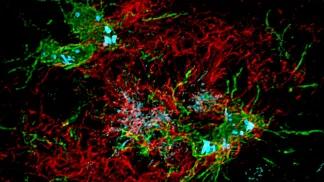 amyloid beta plaque, shown in red, surrounded by microglia, shown in green