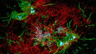 amyloid_beta_plaque_red_surrounded_by_microglia_green_in_mouse_brain