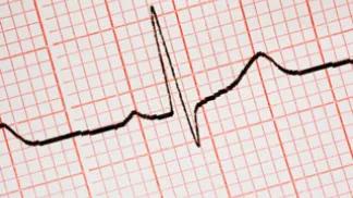 Electrocardiogram