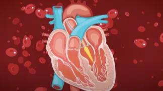 Transcatheter Aortic Valve Replacement