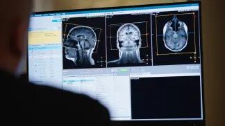 MRI scans of a patient with DIPG. Credit: Erica Bass