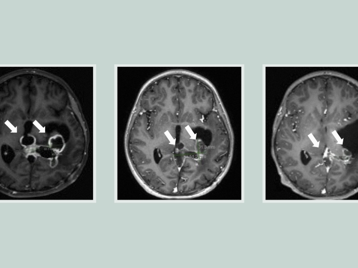 glioma brain scan