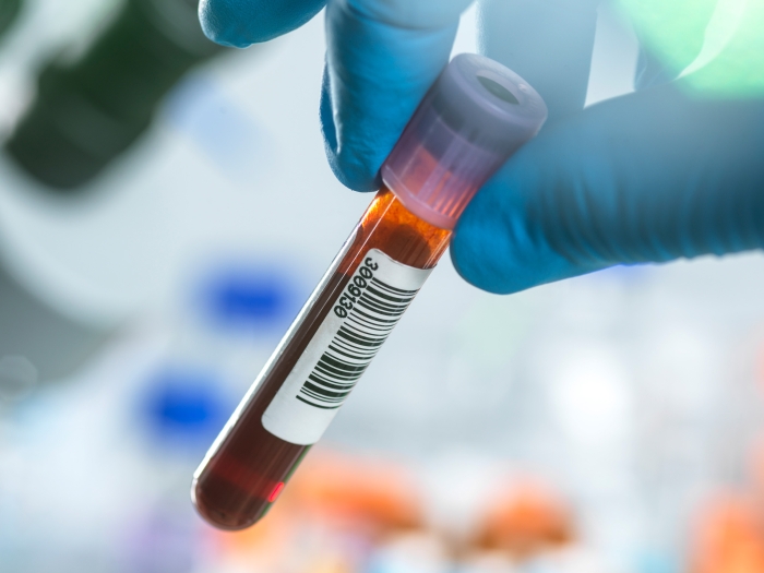 blood sample