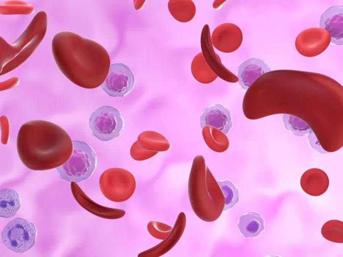 sickle cell gene therapy pink