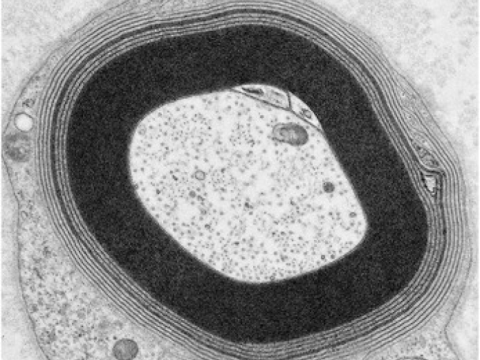 Wide spacing & irregular shaped layers of the myelin in a patient with anti-MAG neuropathy (electron microscopy)