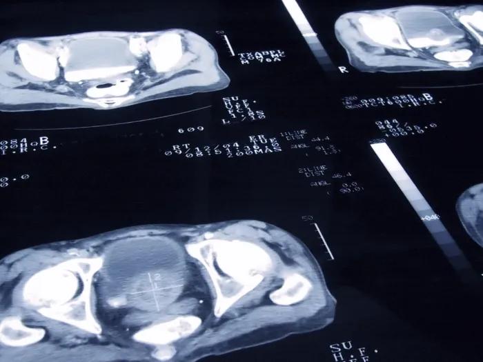 prostate cancer scans