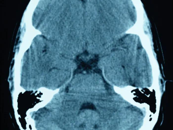 brain scan