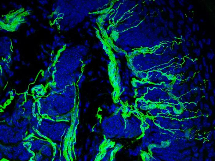assessing intraepidermal nerve fiber density from a skin biopsy showing nerve fibers