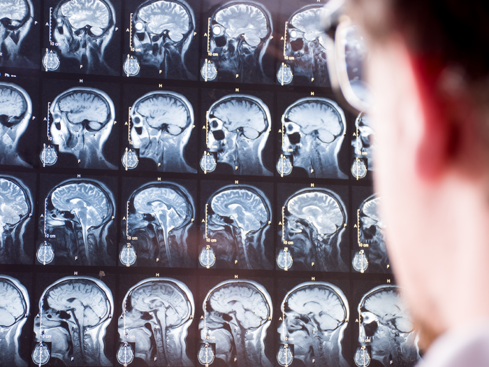 Clinician looking at brain MRI images