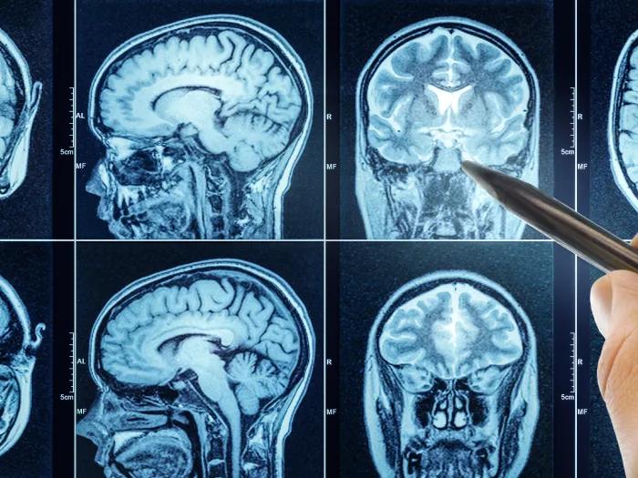 Image of MRI scan 