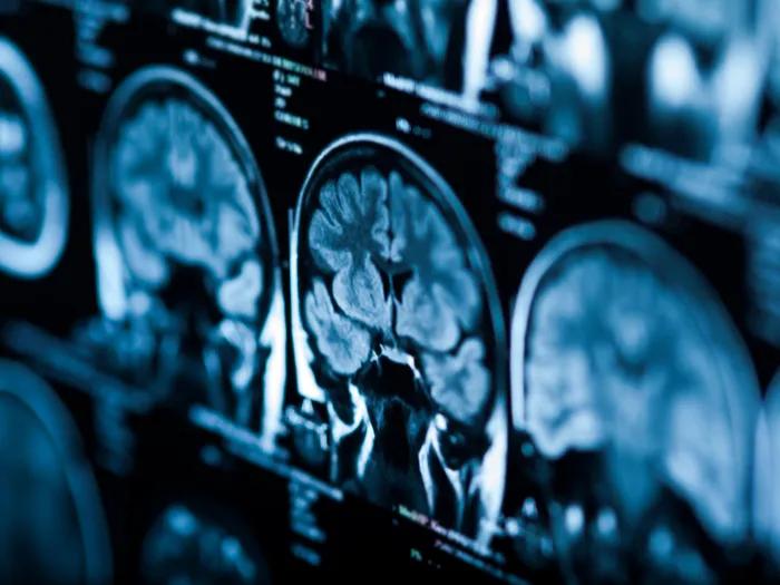 MRI of brain