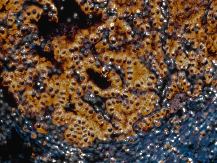 multiplex immunofluorescence / spatial imaging composite of lung tumor tissue