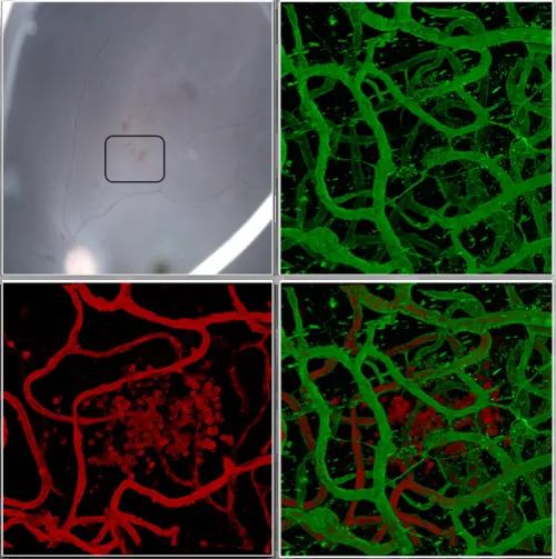 Representative images of fundus photography and immunostaining for the vascular network matrix (green) and a marker of endothelial cells and blood cells (red) at the level of an hemorrhage in the retina of a human donor with diabetes and diabetic retinal disease (DRD).