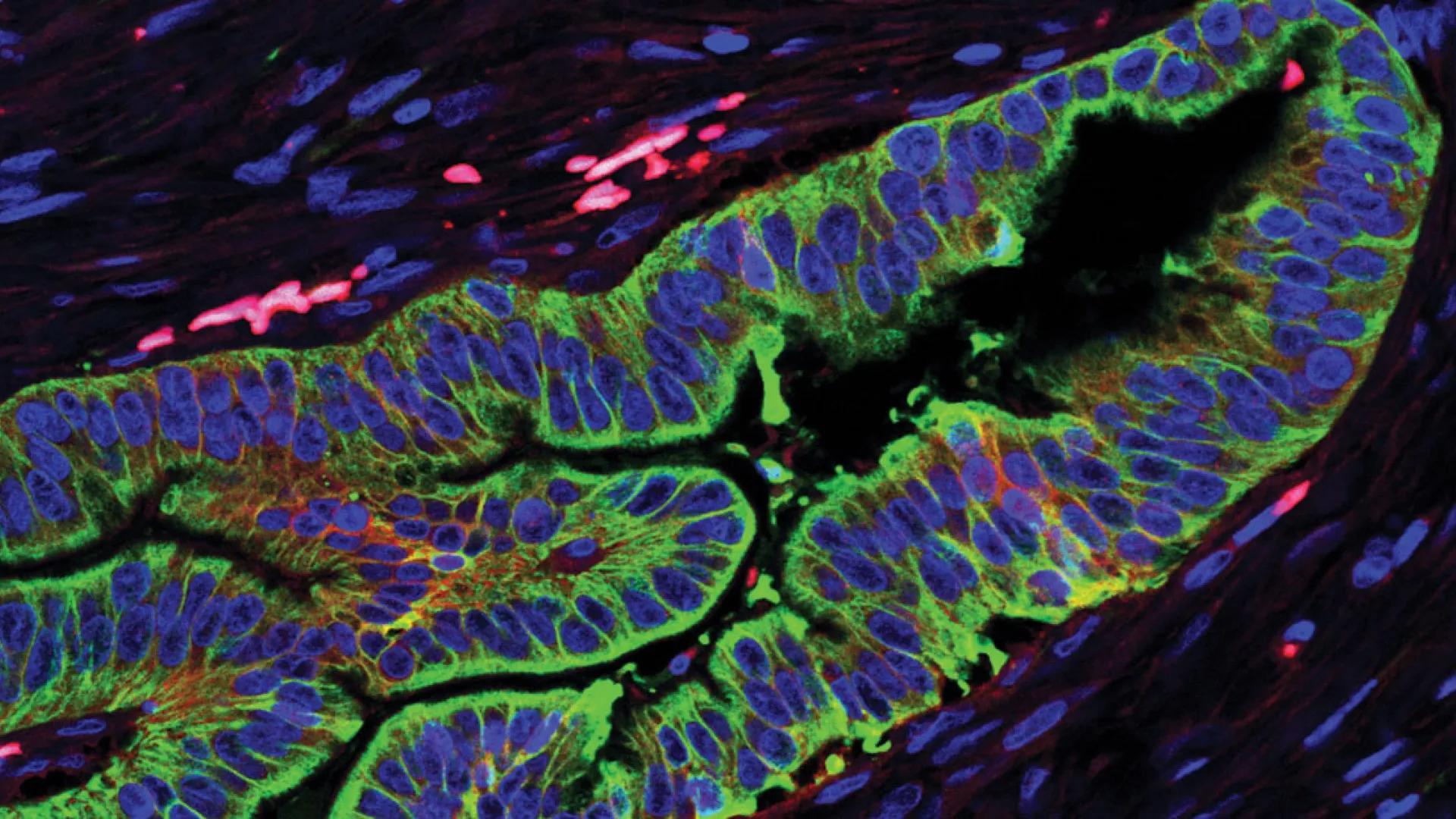 Microscopic view of pancreatic cancer cells colored green and blue