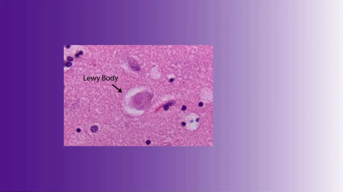 Lewy body image in the brain