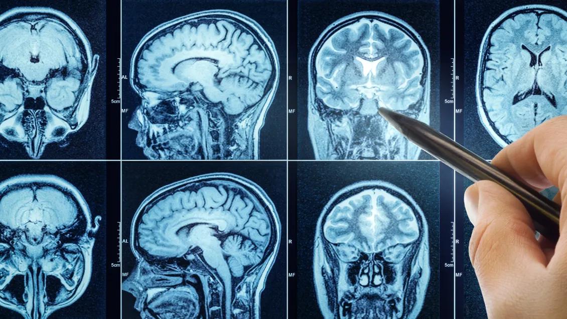 Image of MRI scan 
