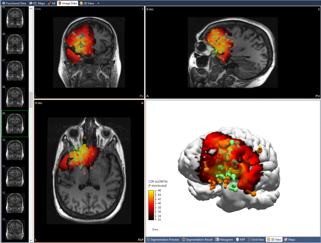 MRI images of a brain showing different parts of the brain