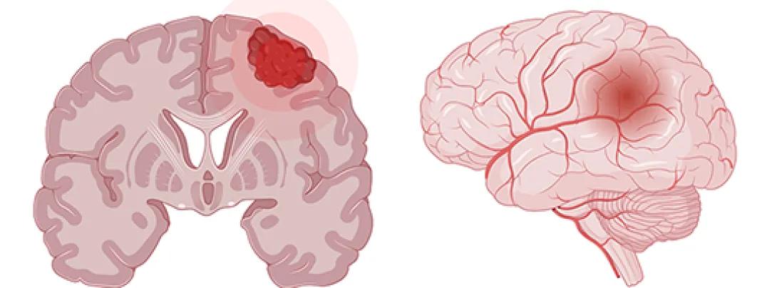 front and profile view of a human brain