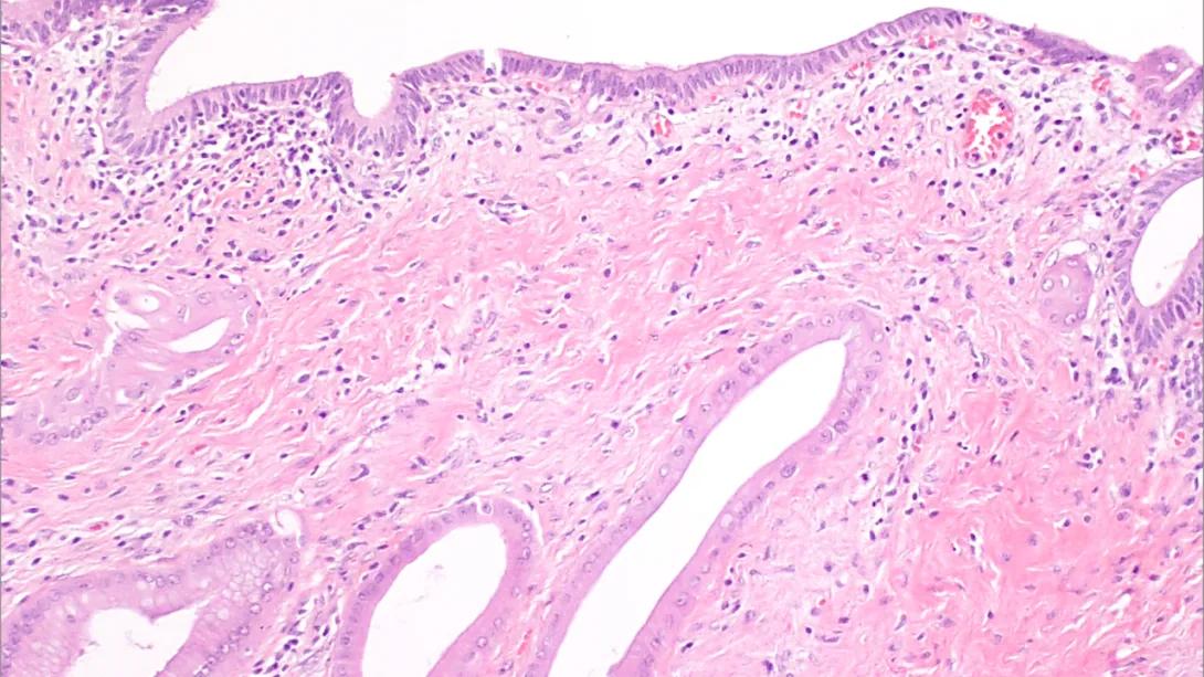 Human biliary samples