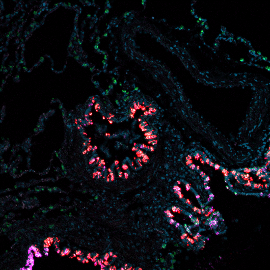 stained tumor tissue under microscope
