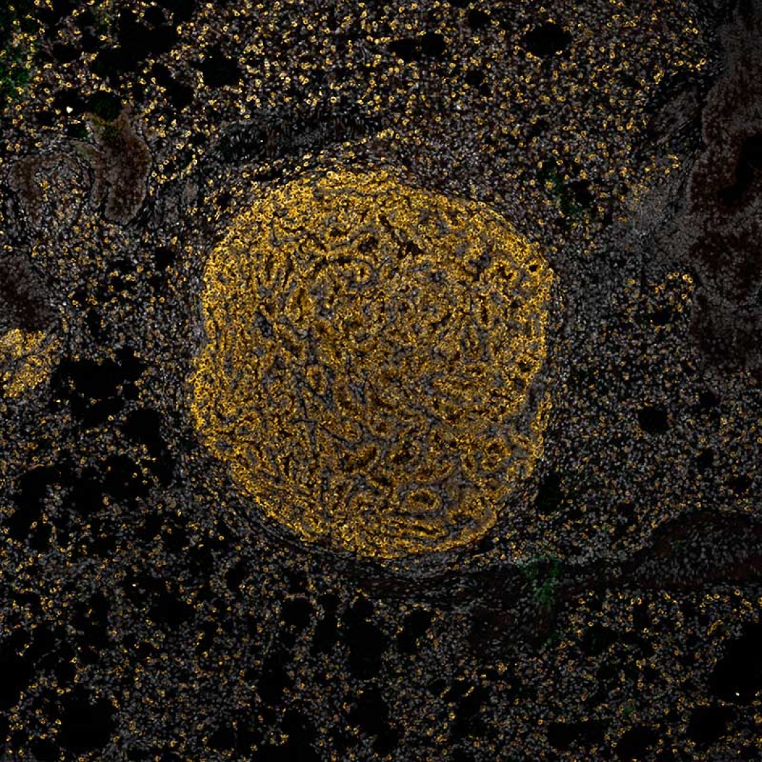 Cancer cell stained brown on a black background